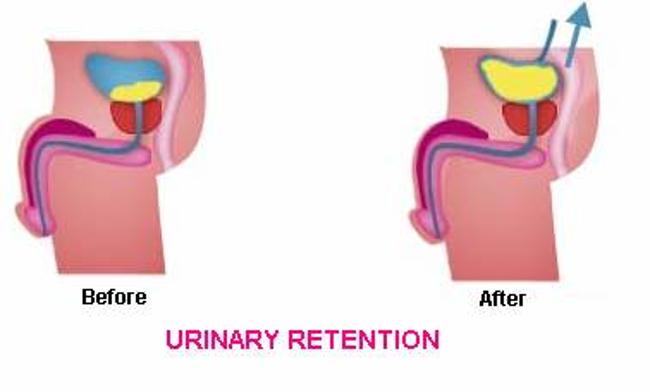 Urine Retention 