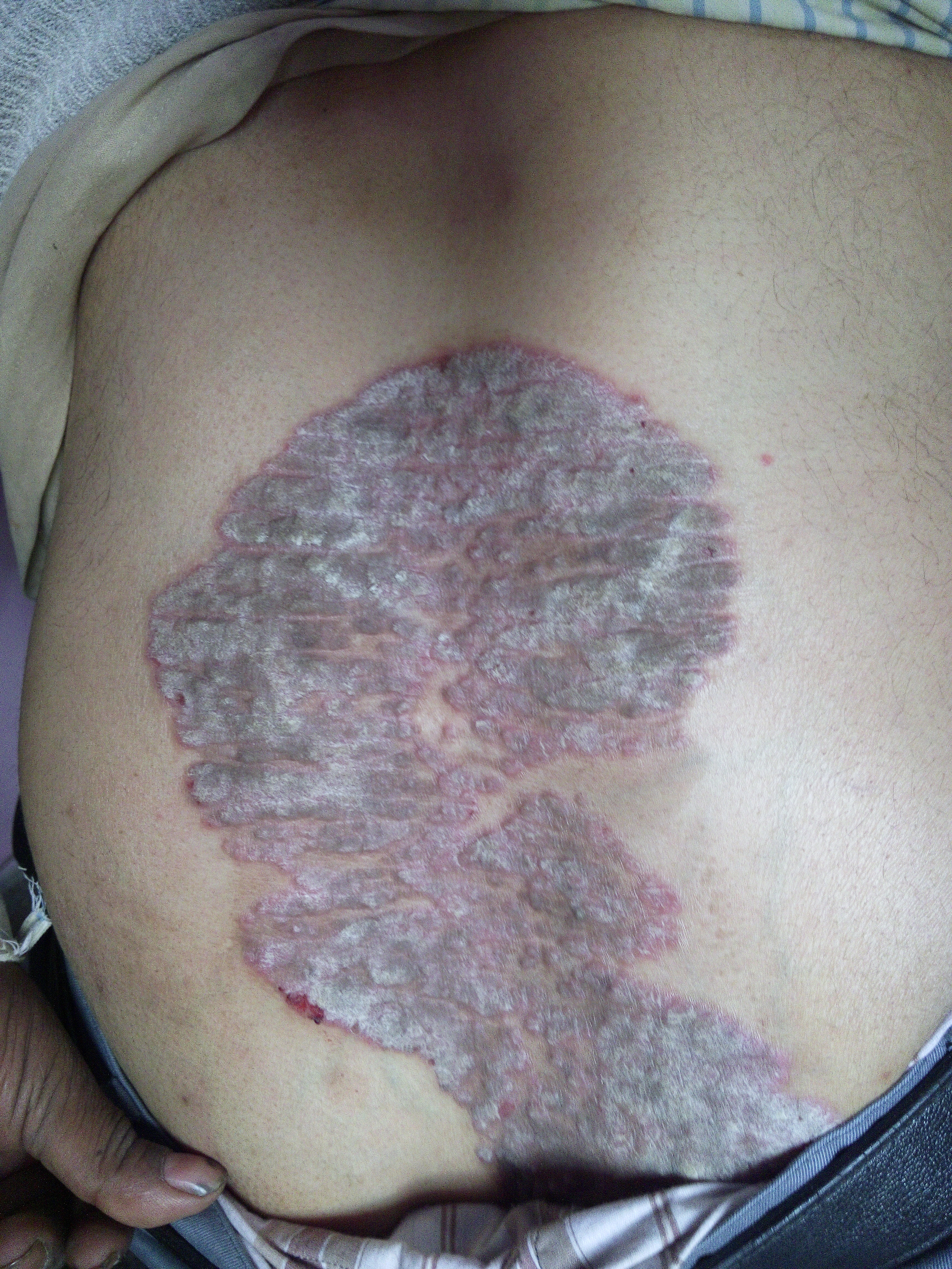  Lesions over back and elbow - diagnosis and management