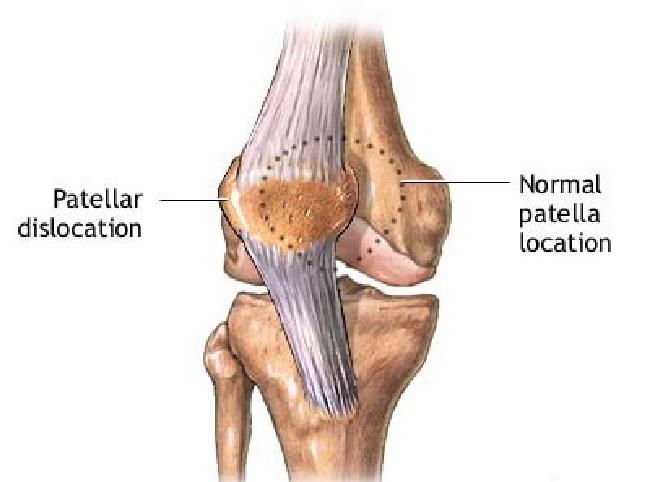 Transient patellar shop dislocation treatment