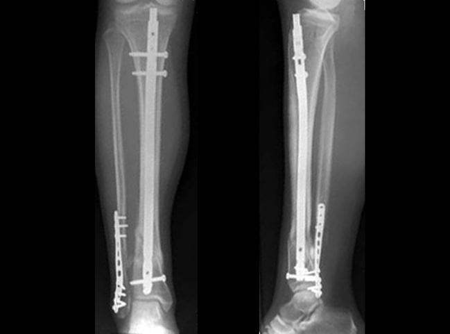 Intramedullary Nailing For Distal Tibia Fractures