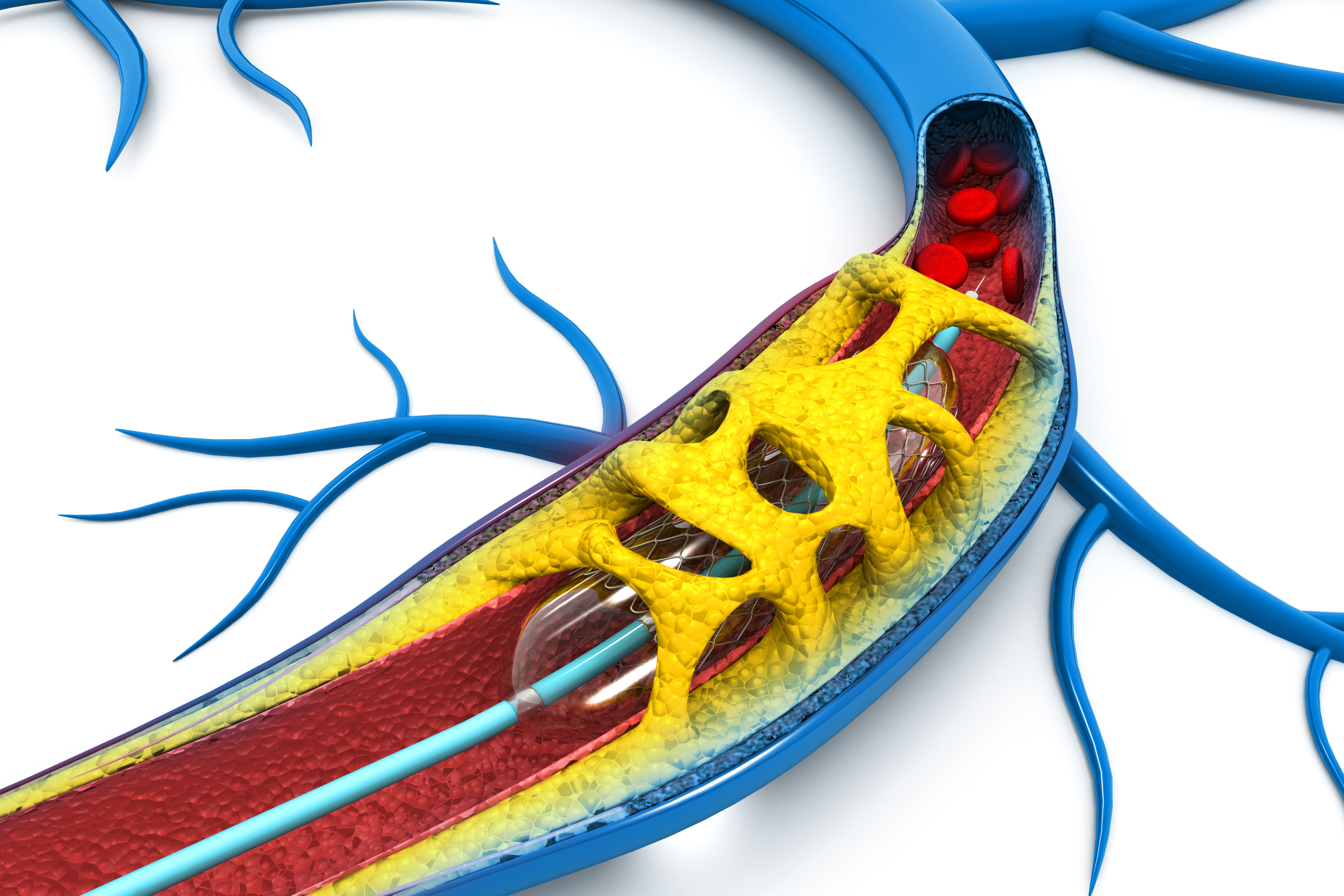 Bioabsorbable Stents, For Treatment Of Coronary Artery Disease