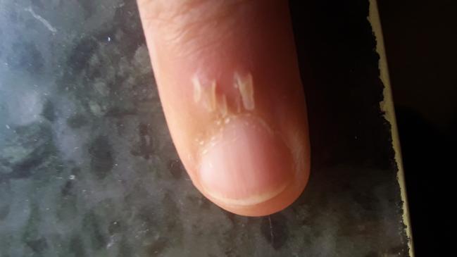 dermdx-pain-at-fingernail-base-dermatology-advisor