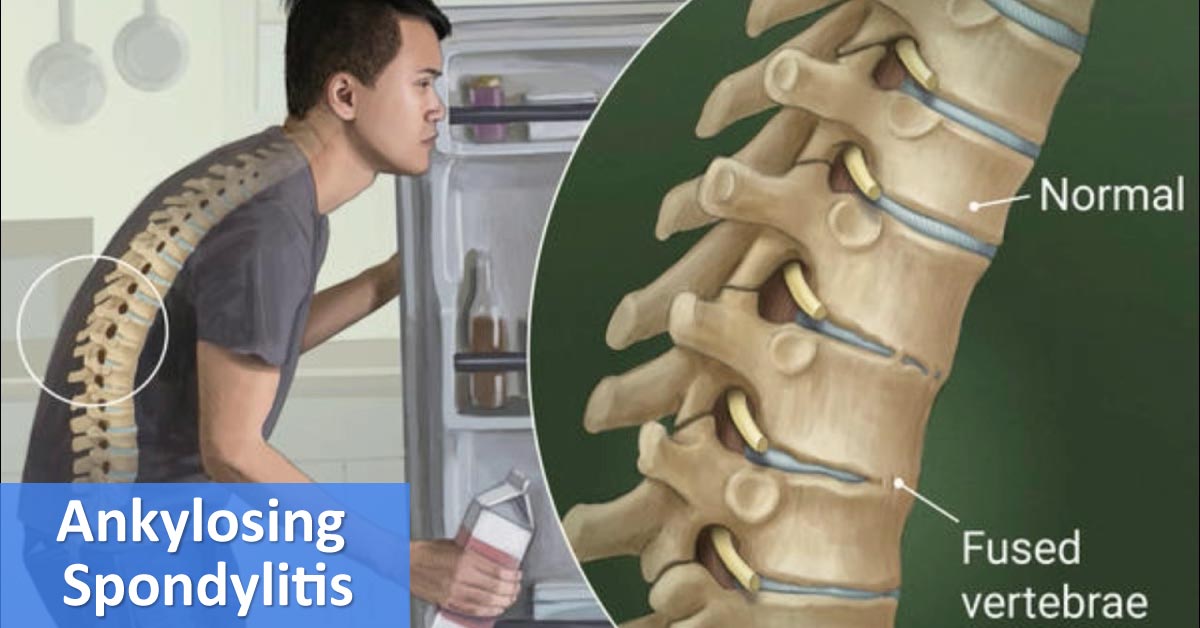 Ankylosing Spondylitis: Management Recommendations