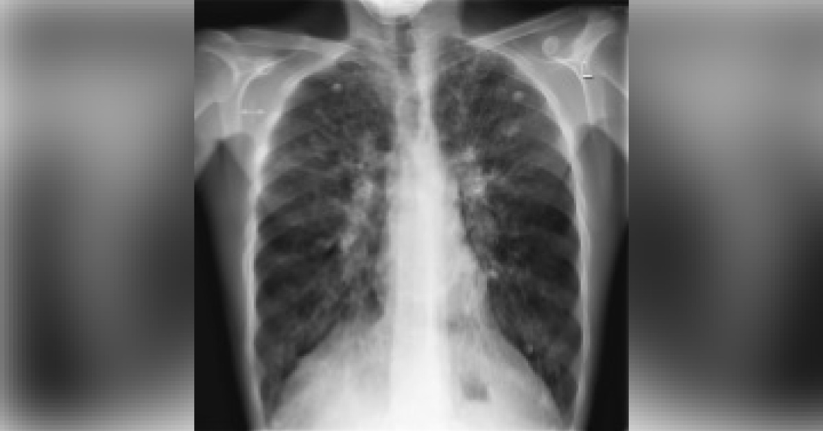 What Is Causing Repeated Chest Infections In This Boy?