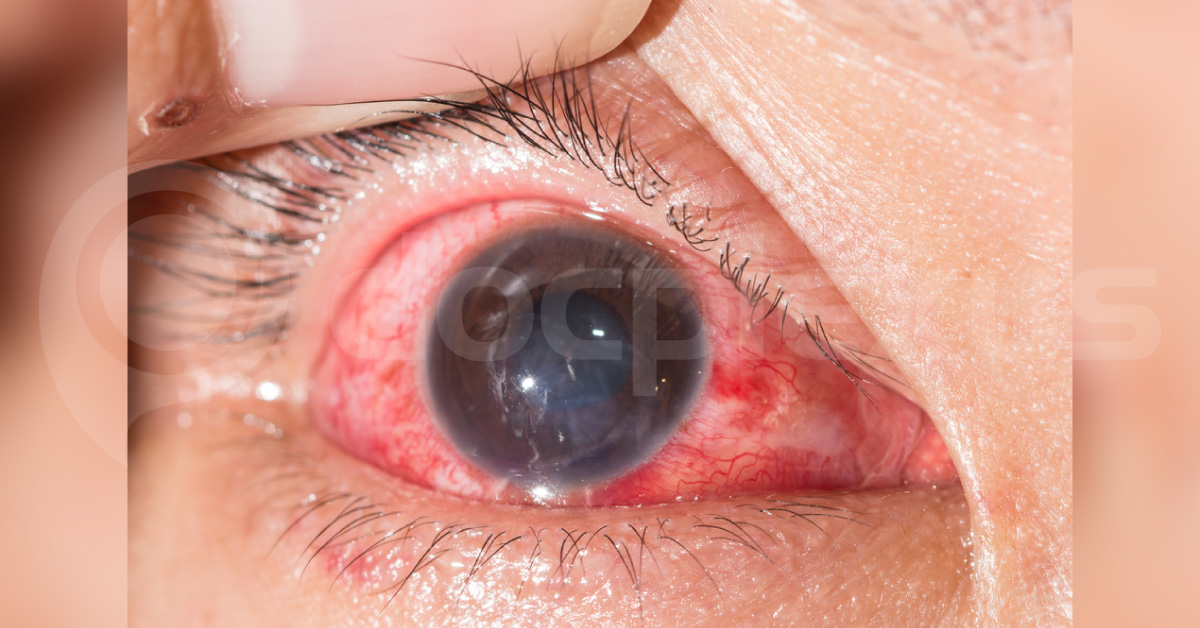 What Caused Increased Lacrimation In This Patient