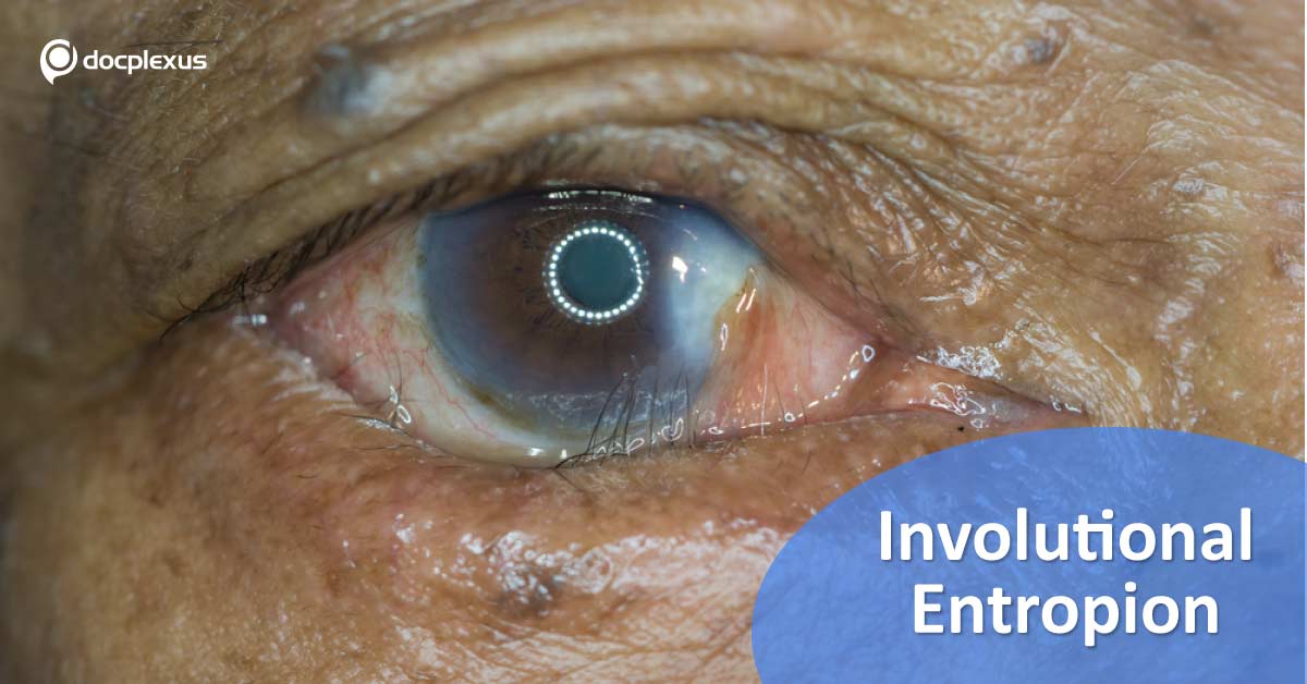 Surgical Techniques For Involutional Entropion