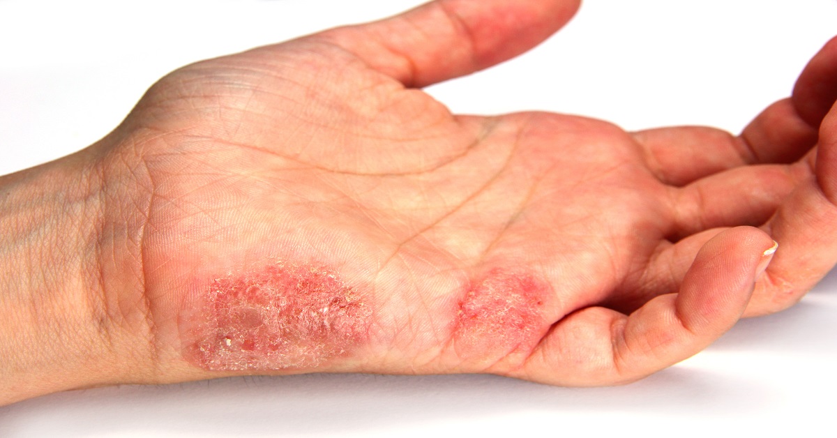 Making A Choice Of Antifungal For Dermal Conditions