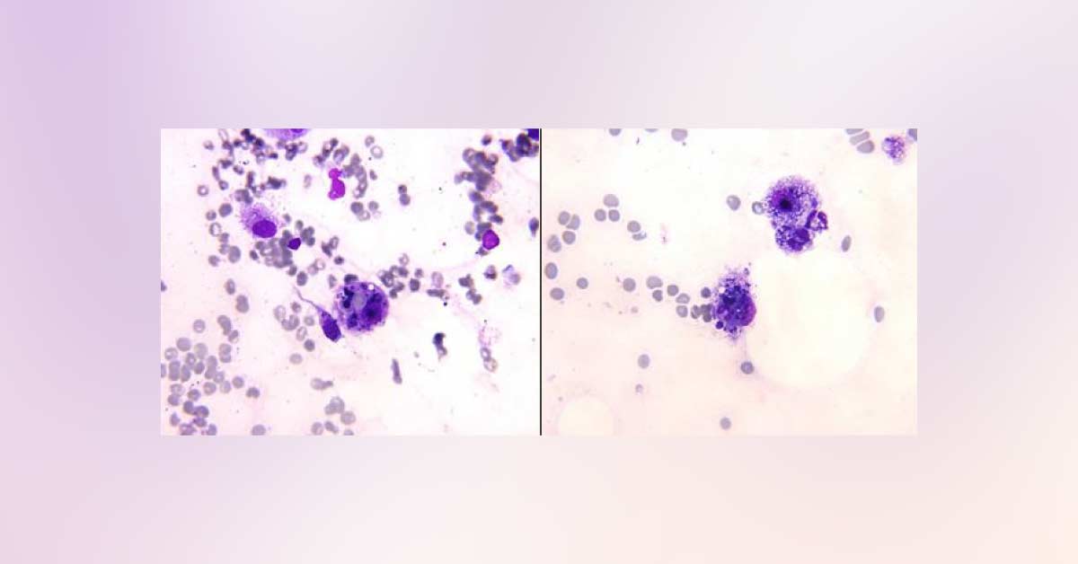 Identify This Hematology Disorder