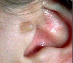 Goldenhars Syndrome A Brief Review