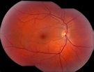 Preeclampsia And Fundus Changes, A Brief Scenario