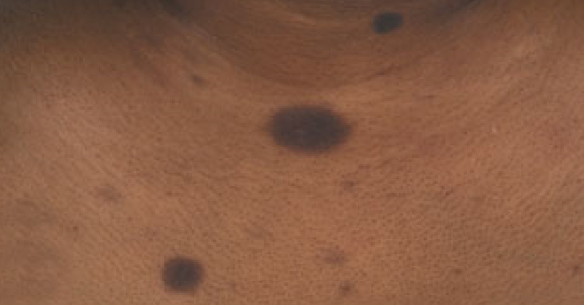 What Is Causing These Lesions?