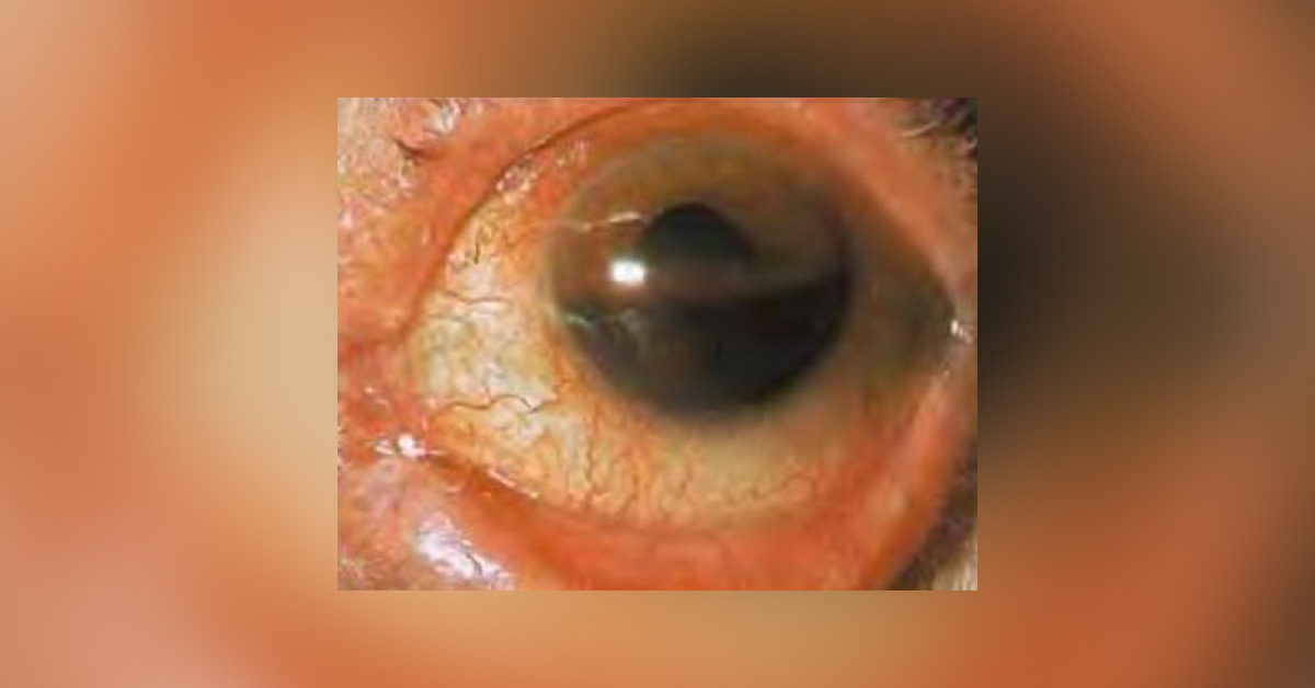 Hyphaema: A Brief Review