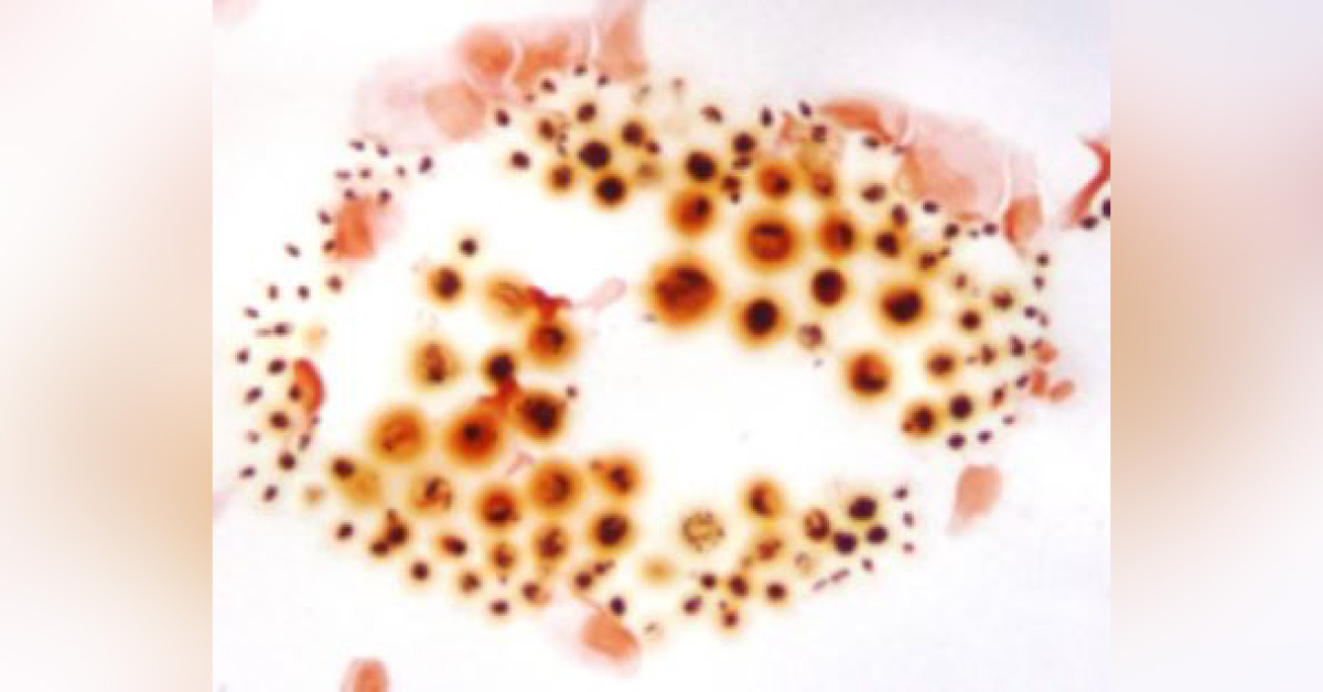 Chronic Liver Disease And Headache In An Old Man