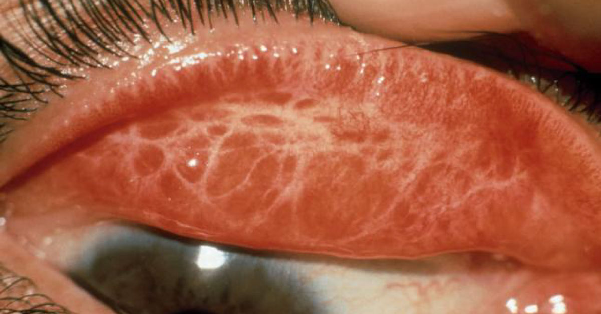 History Of Trachoma