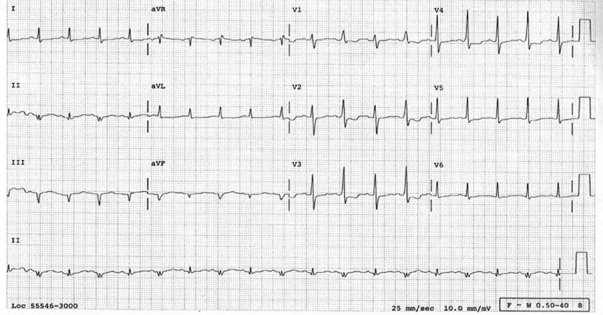 Solve This Puzzling ECG