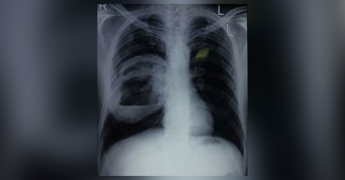 Differential Diagnosis X- Ray Chest
