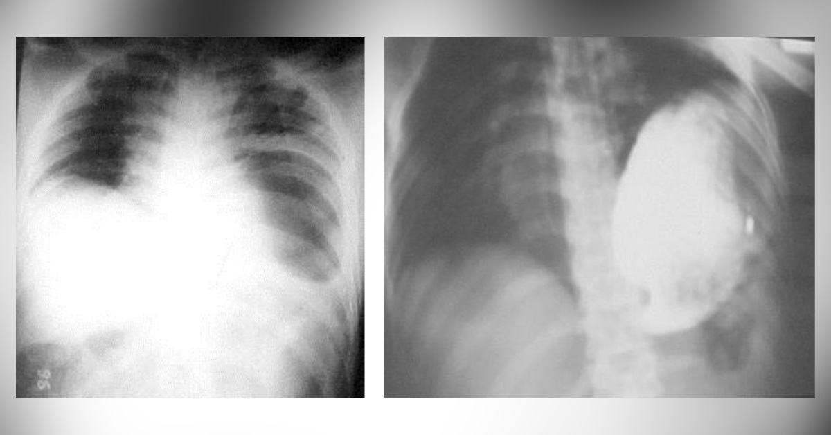 Suggest Management For Abdomen And Chest Injury
