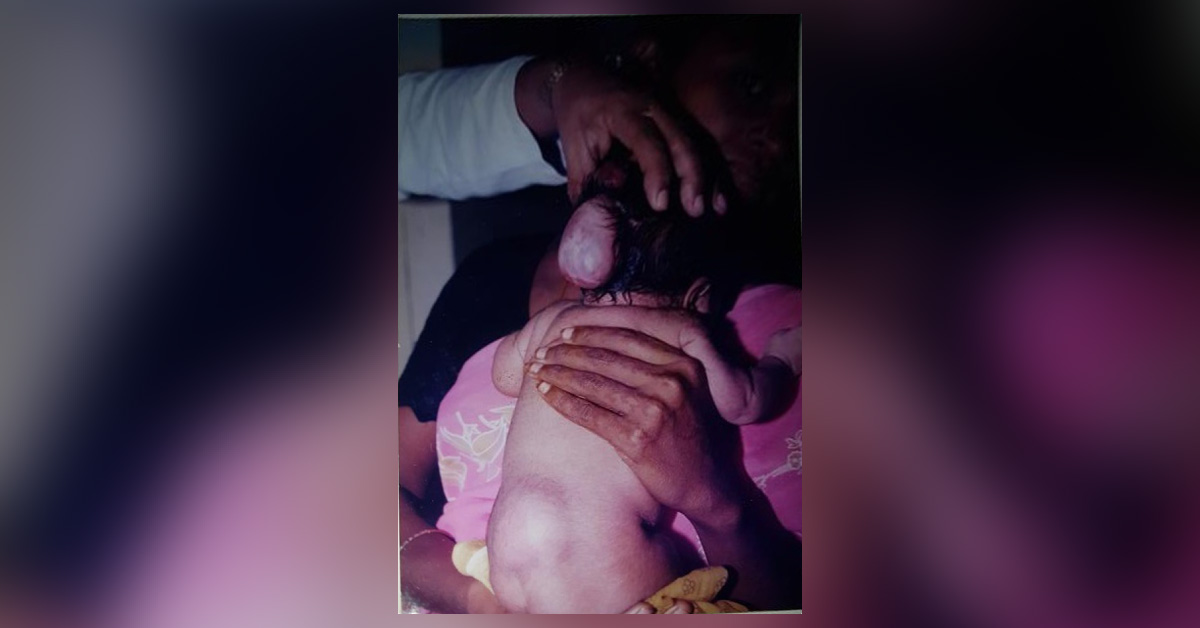 Spot The Diagnosis In A New Born Baby With Two Swellings 