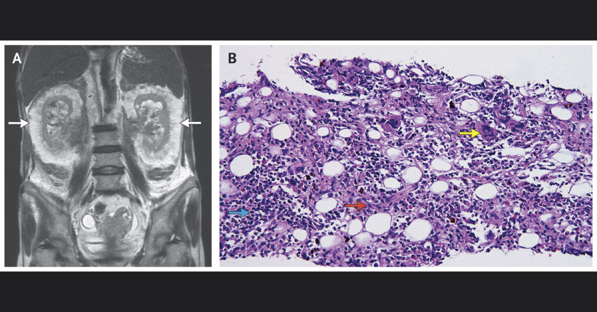 Identify Abnormality In Perirenal Region