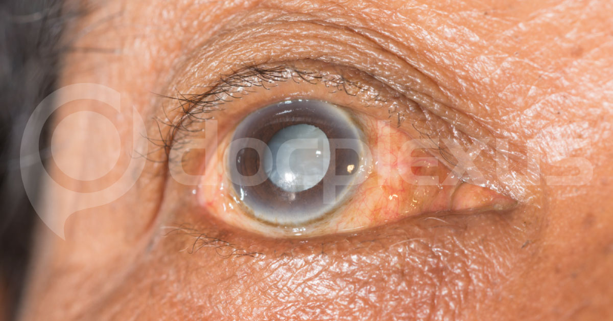 Brief Review Of Cataract Surgery