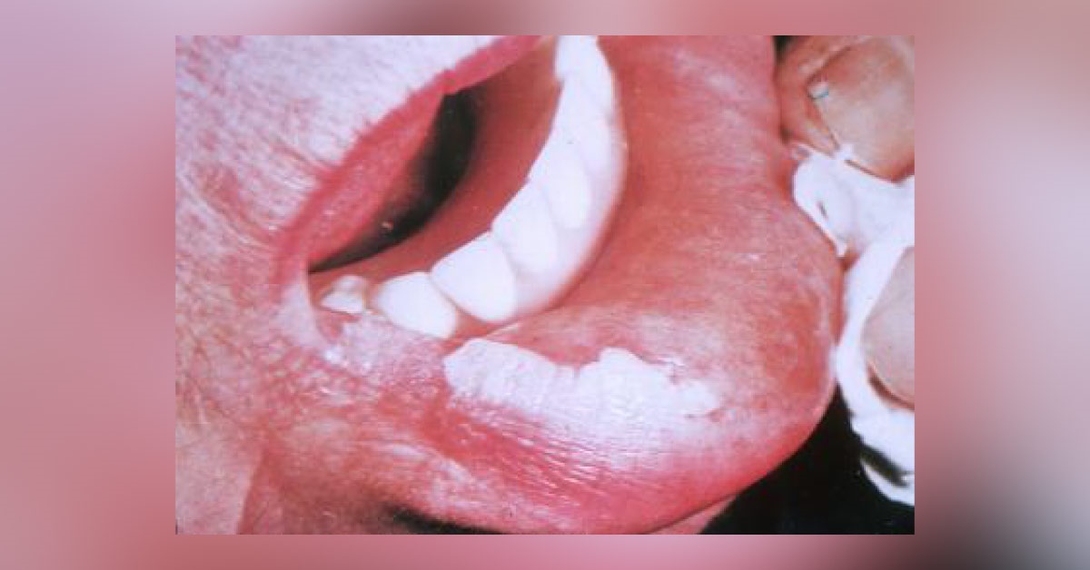 Oral leukoplakia, Risk Factors For Malignant Transformation