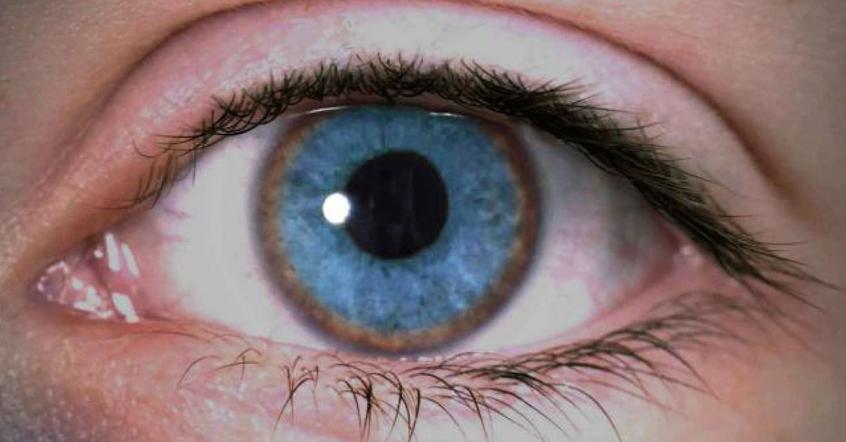 Ocular Manifestations Of Wilsons Disease