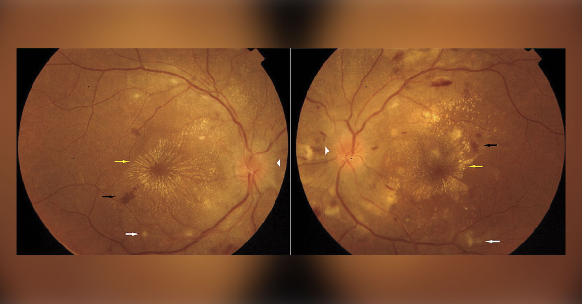 Identify This Condition In A Young Woman