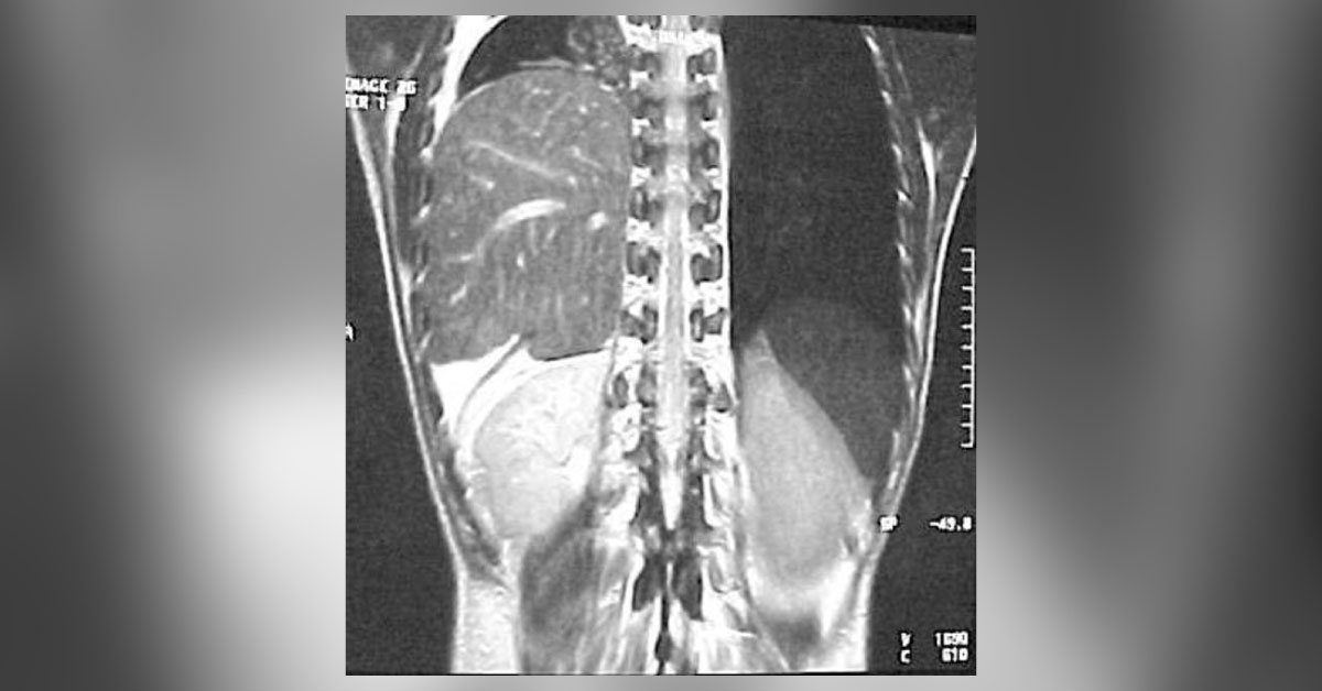 Conclude This Chest X-ray