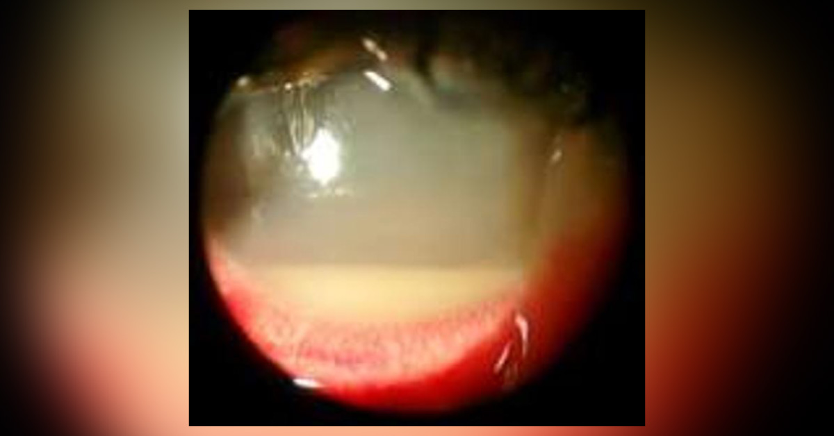 Hypopyon Brief Review
