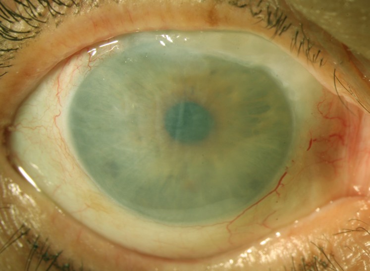 Corneal Oedema, A Brief Scenerio