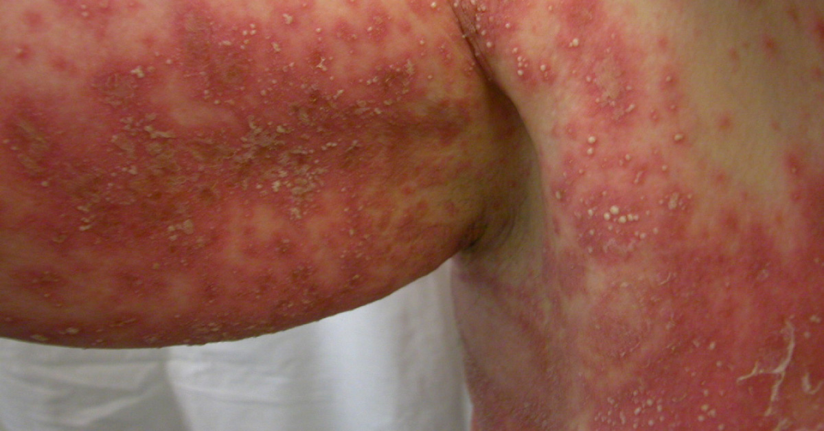 Solve This Dermatology Case