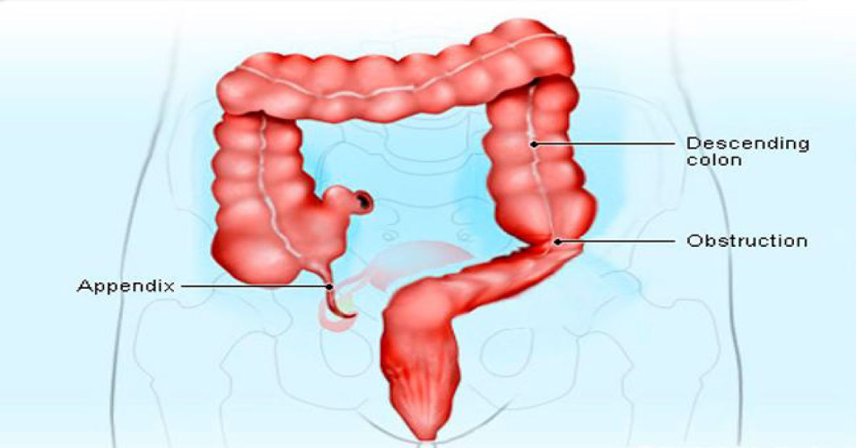 Digital Artifical Intelligence Can Detect Colorectal Cancer With 86% Accuracy