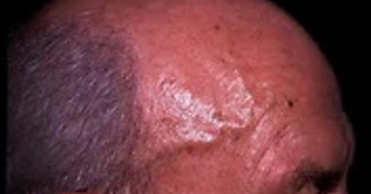 Temporal Arteritis A Brief Review