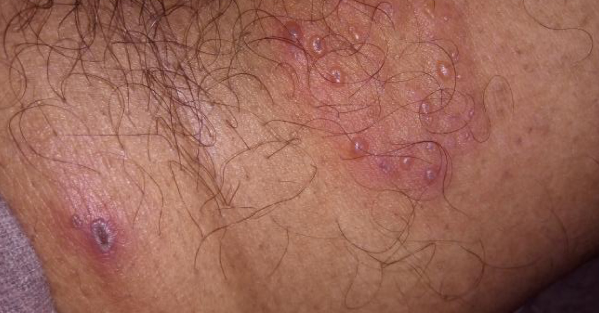 Painful Reddish Skin Lesion In Groin