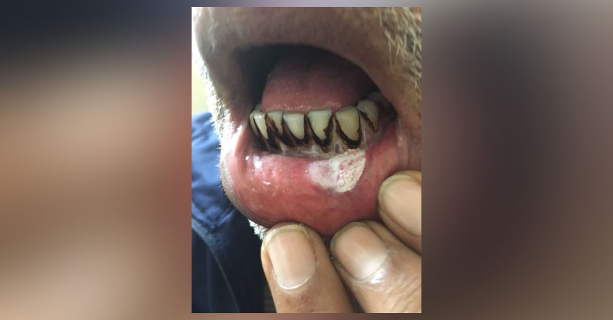 Management Of Dysplasia In Tobacco User