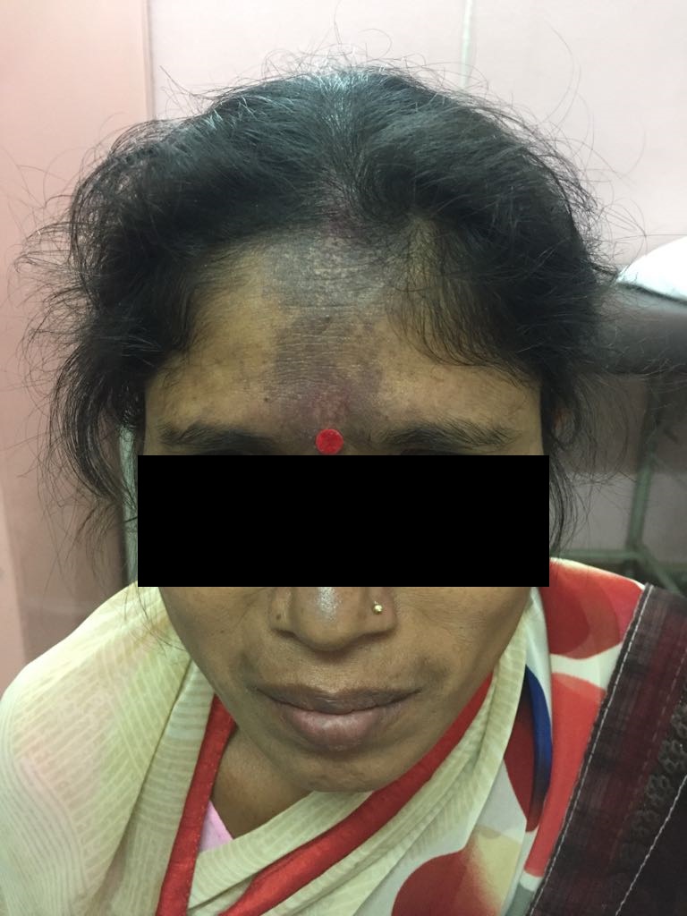 Is There Any Specific Treatment For Such Skin Lesions? 