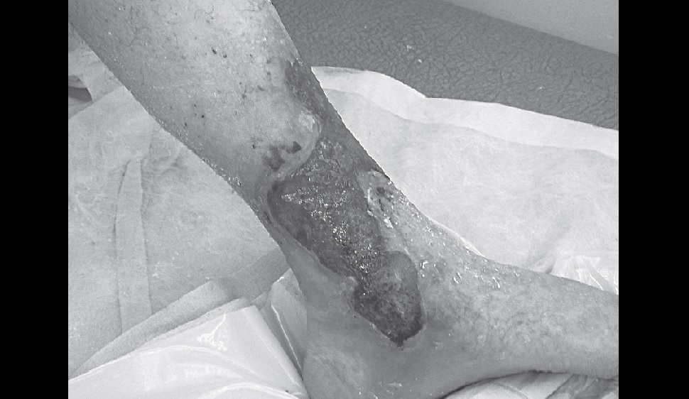 Can You Resolve This Case Of Venous Ulceration?