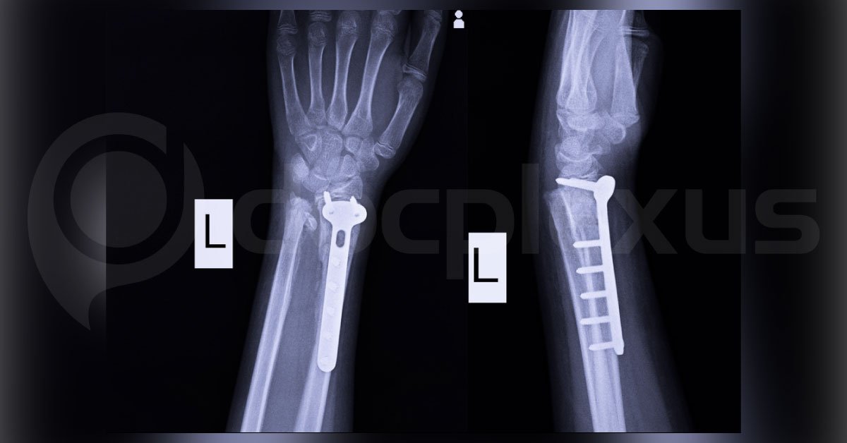 Intramedullary Nail For Treating Diaphyseal Forearm Fractures