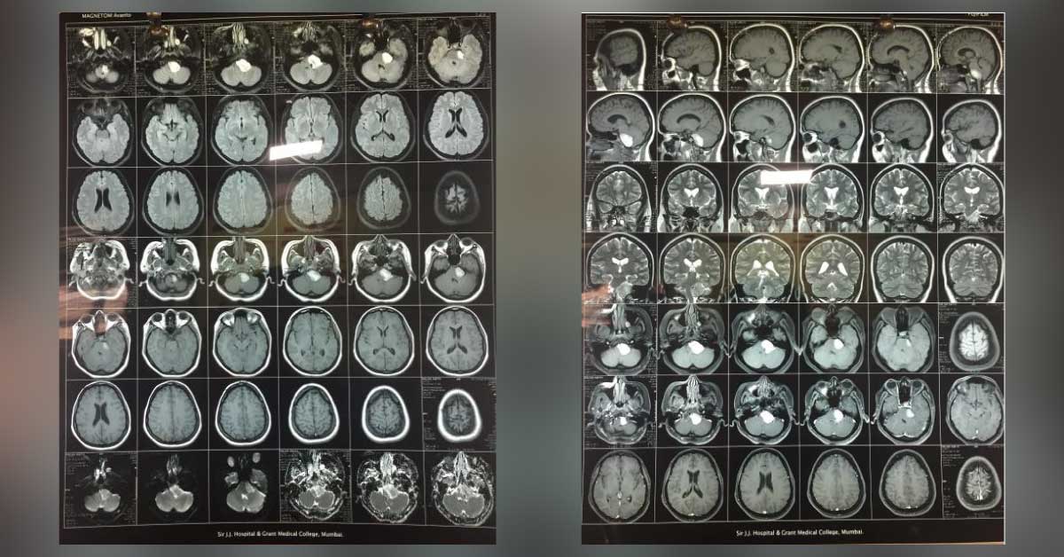 Retrosigmoid Approach To Resection Of Cerebellopontine Angle Craniopharyngioma