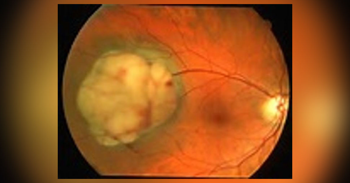 Modalities Of Treatment In Cases Of Choroidal Melanoma