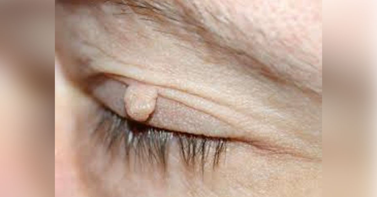 Very Brief Scenario Of Pendulous Palpebrum Or Pityriasis Palpebrarum