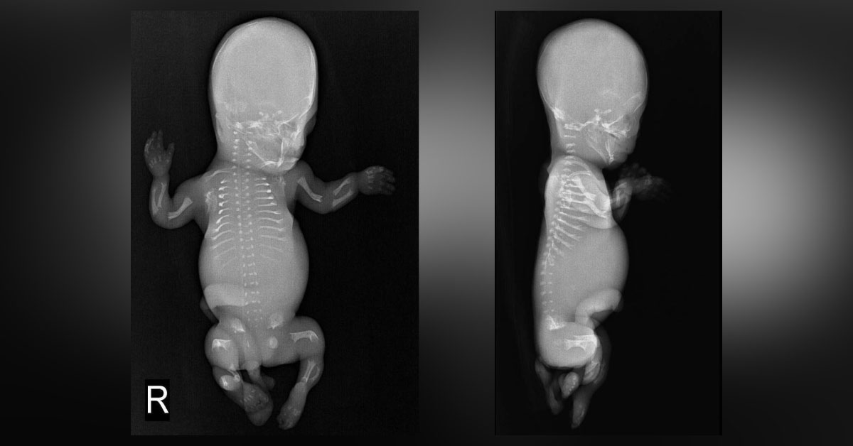 Identify Cause For Pregnancy Termination