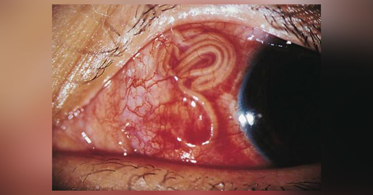Ocular Parasites A Brief Review