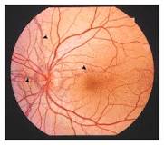 Ocular Manifestations Of AIDS
