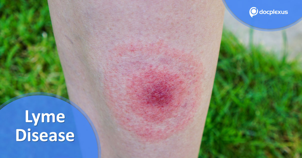 Overcoming The Diagnosis Barrier: Breakthrough In Lyme Disease