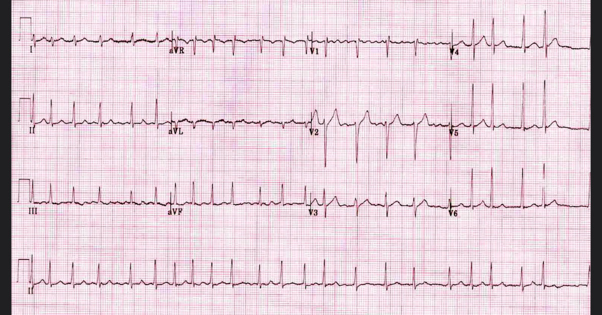 Identify This Condition From Attached ECG Only