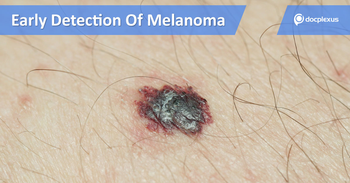 Advanced Imaging Techniques For Early Detection Of Melanoma
