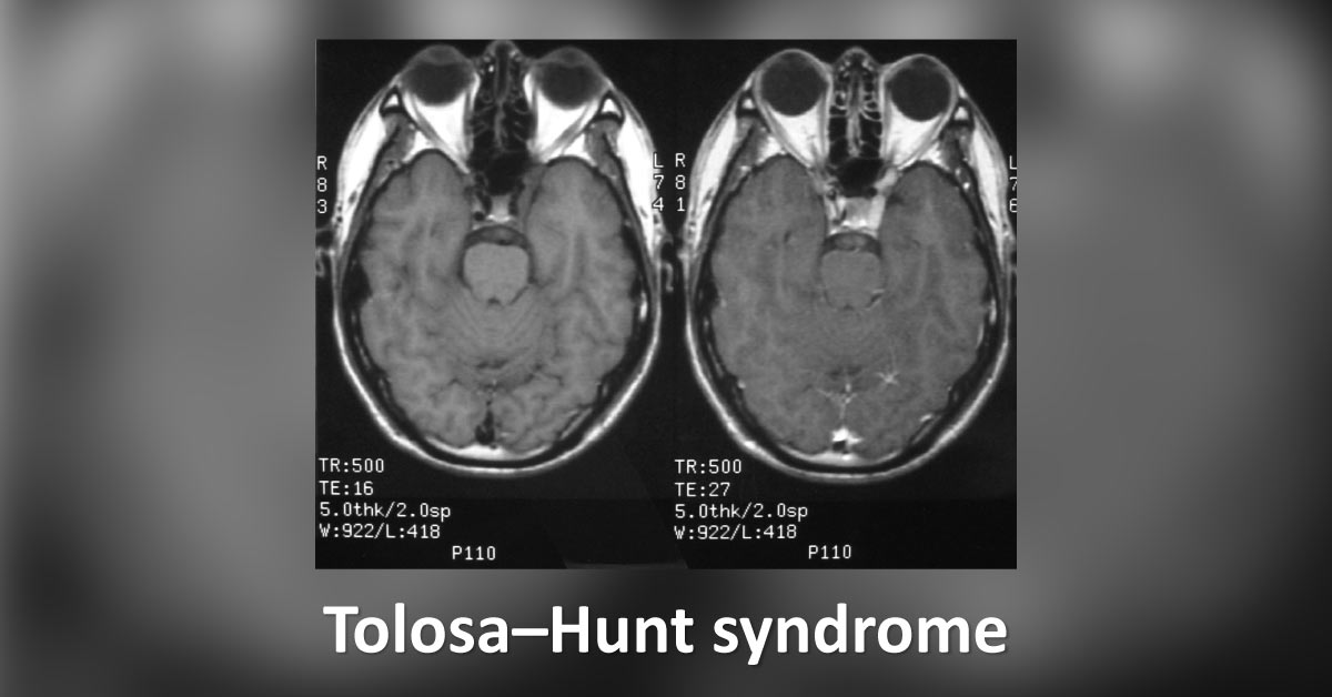 Ocular Manifestations Of Tolosa Hunt Syndrome