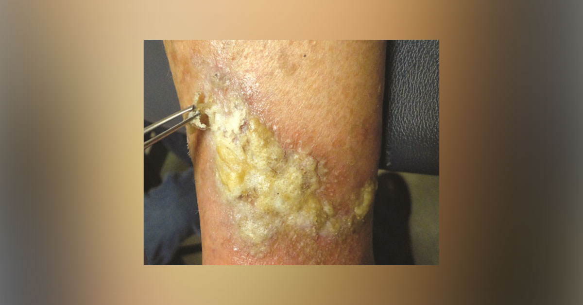 Is This Pembrolizumab Induced Reaction?