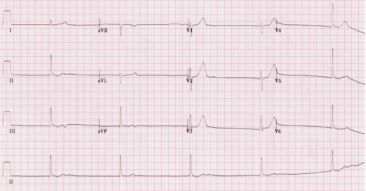 Identify This Cardiovascular Complication